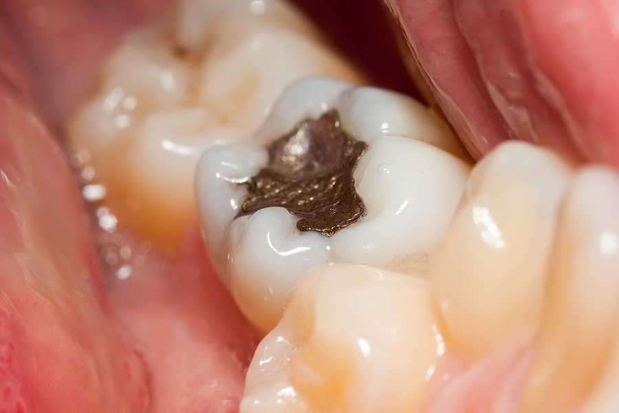 Why Dental Fillings Are Important for Your Child’s Smile: A Guide for Parents
