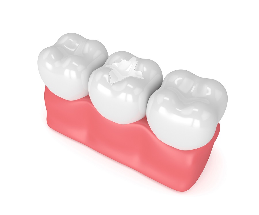 How Sealant enhance dental health?