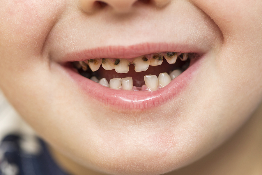 4 Ways to Protect Your Teeth From Cavities