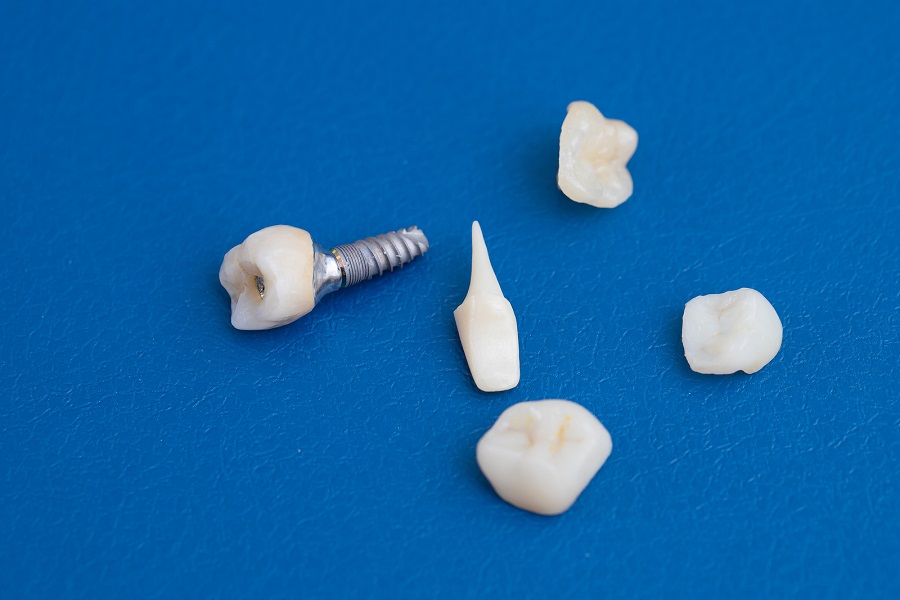 What is a Dental Crown?