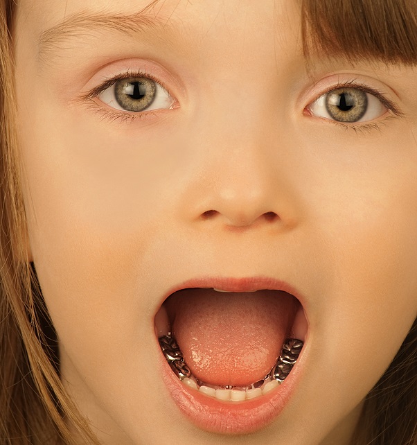 Main steps of the pediatric dental crown procedure
