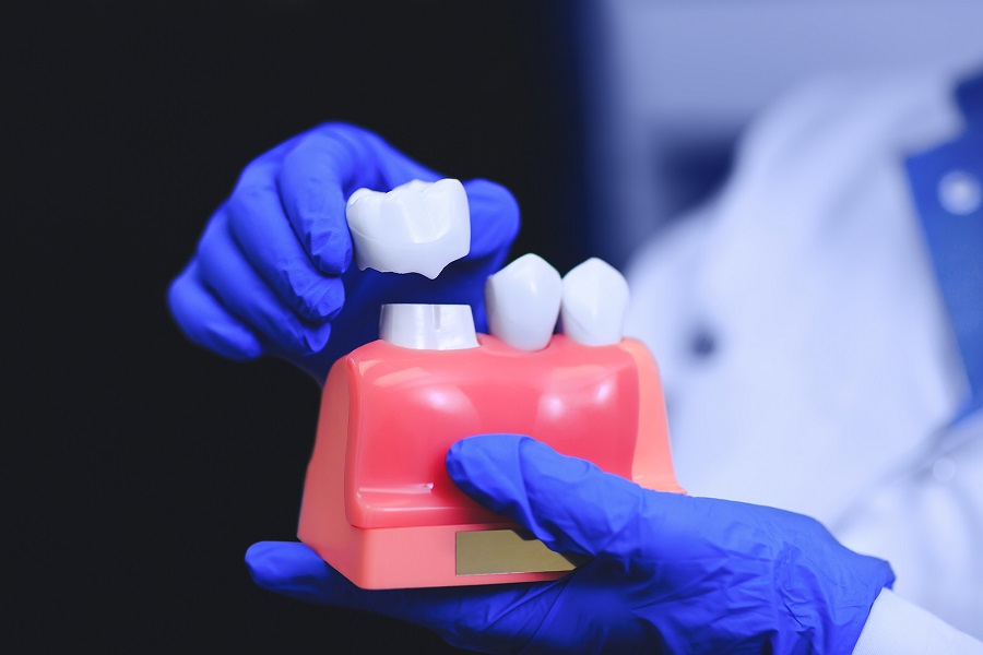 How long will a dental crown last and when you need this?