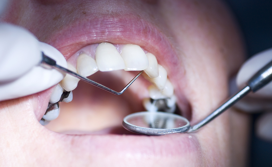 Dental Sealants for Kids